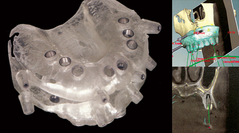 サージカルテンプレート